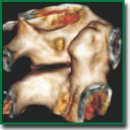 Использование нейронных сетей для оценки возрастных изменений некоторых структур черепа и шейных позвонков по данным КТ-снимков (пилотный проект)