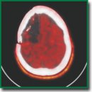 Stereotactic Photodynamic Therapy of Recurrent Malignant Gliomas